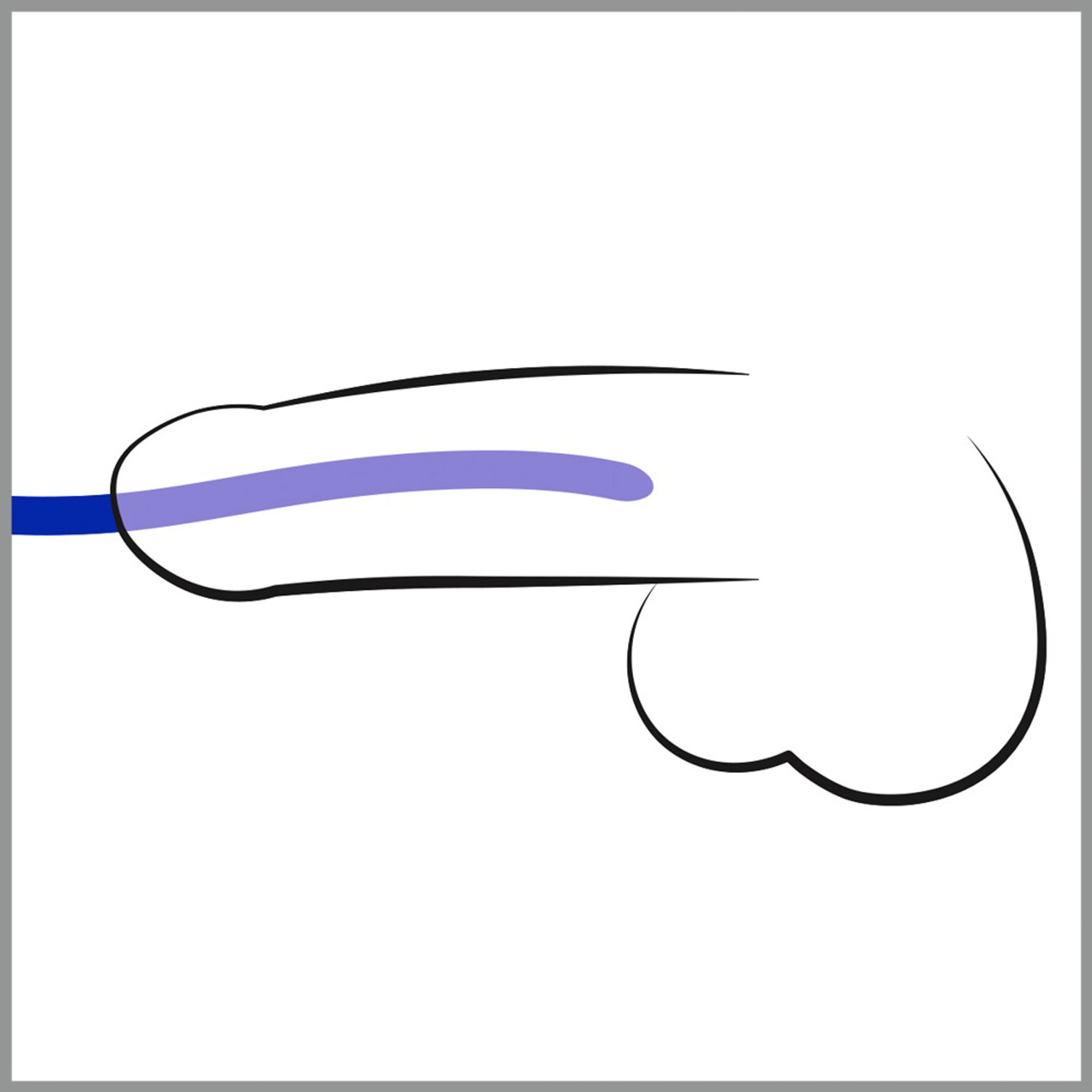  Artikelbild 3 des Artikels “Silikon Dilator 3er Set “